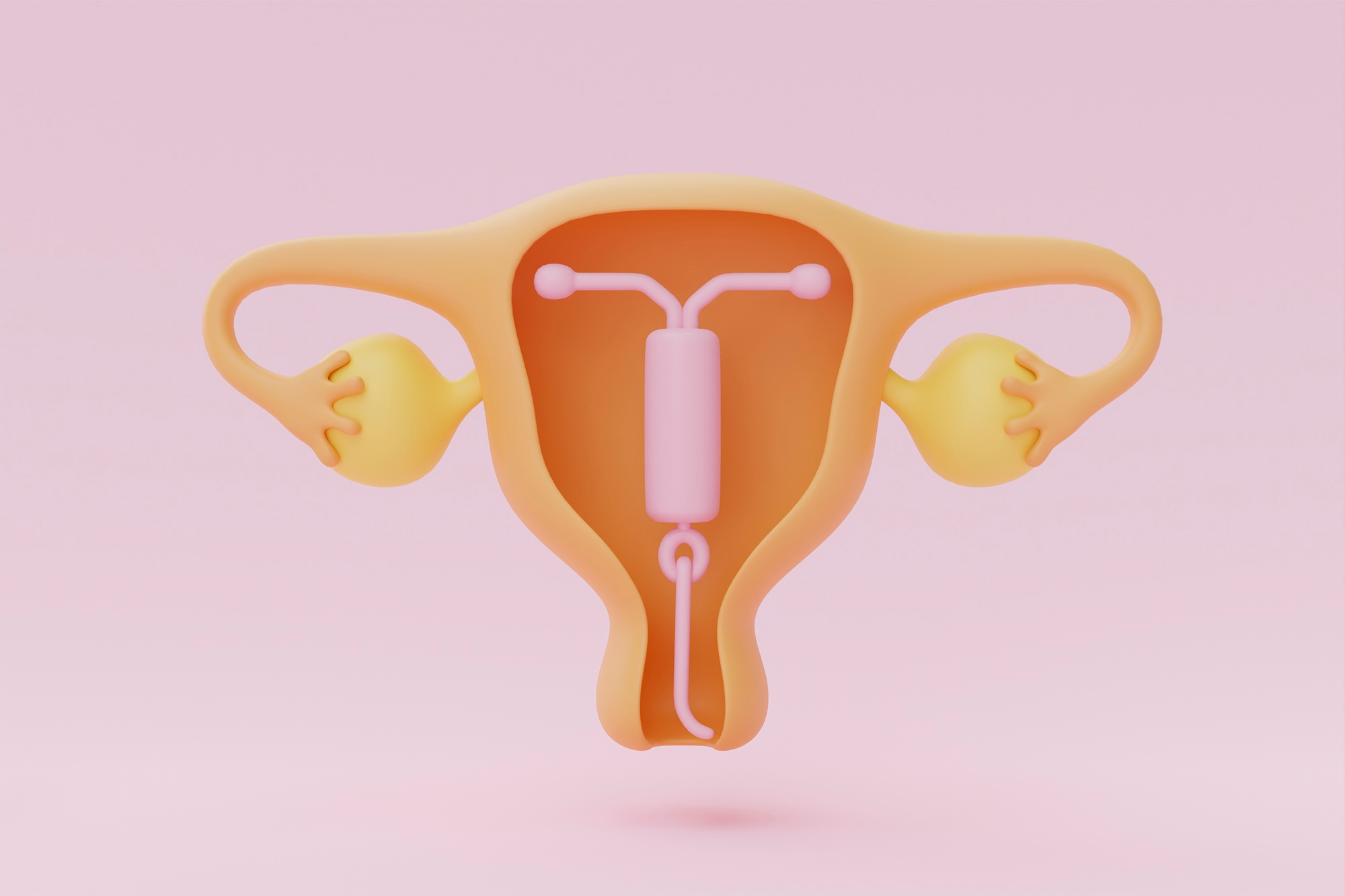 DIU - Dispositivo intra uterino